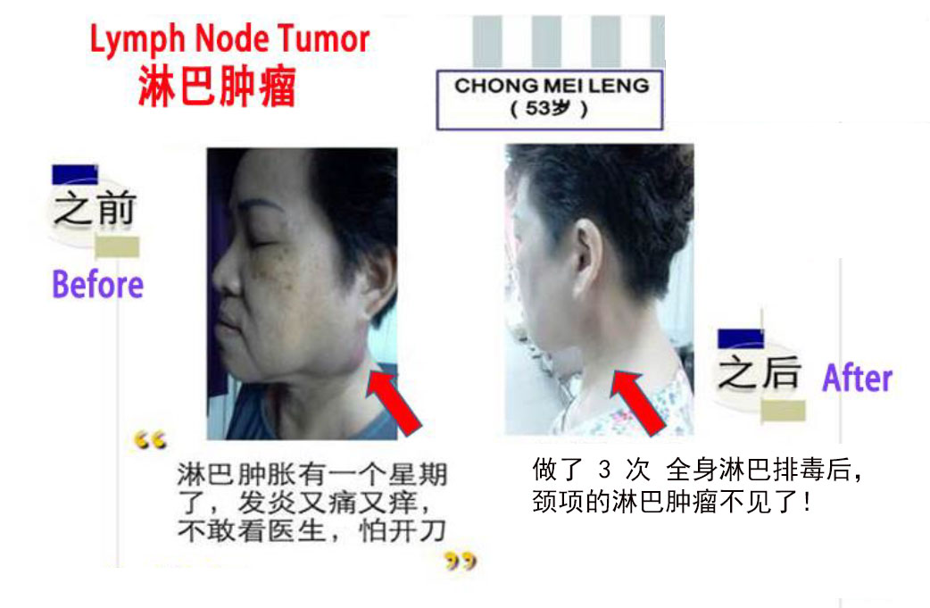 颈项淋巴肿瘤